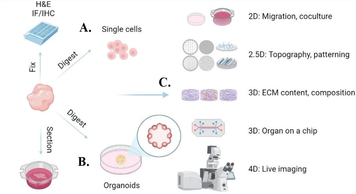 Breast cancer ductal carcinoma.