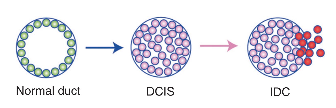 Fig.1 Progression of ductal carcinoma in situ to invasive breast cancer. (Van Seijen M., et al. 2019)