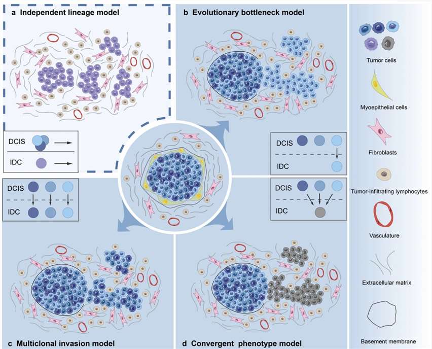 Fig.1 Proposed models of DCIS progression. (Wang J., et al. 2024)