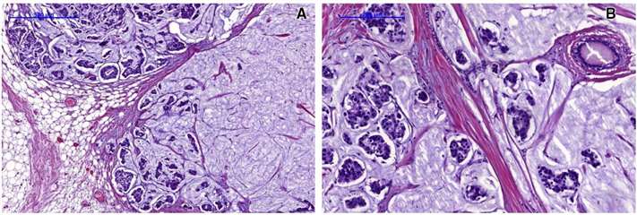 Fig.1 Histopathological image of pure mucinous breast cancer (PMBC) (grade 2, H&E)-characteristic cancer cells “nests” foating in abundant extracellular mucus. (Budzik M.P., et al. 2021)