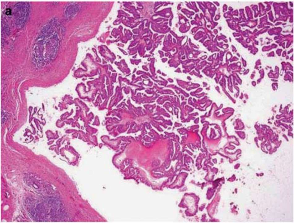 Fig.1 Examples of papillary carcinoma of the breast displaying papillary architecture features. (Hameed O., et al. 2009)