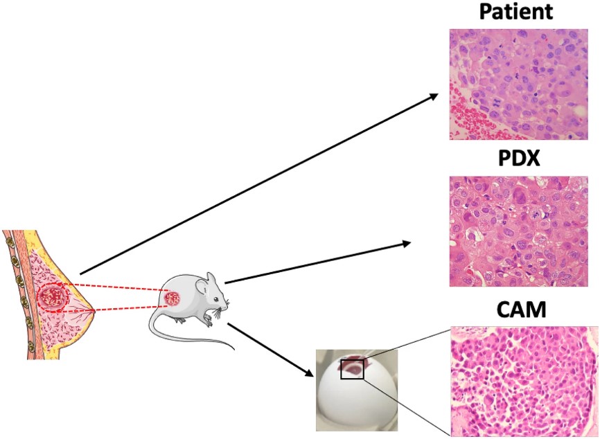 Construction of PDX of breast cancer.