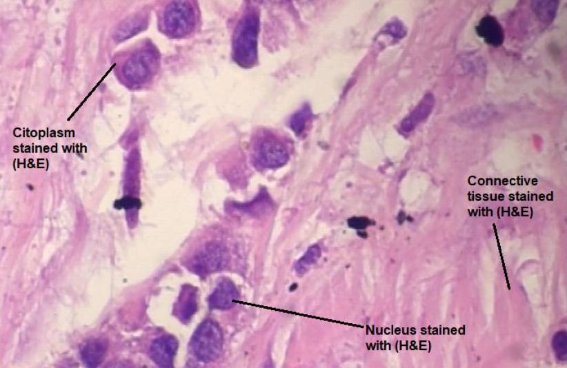 H and E stained digital histology image sample of lobular carcinoma.