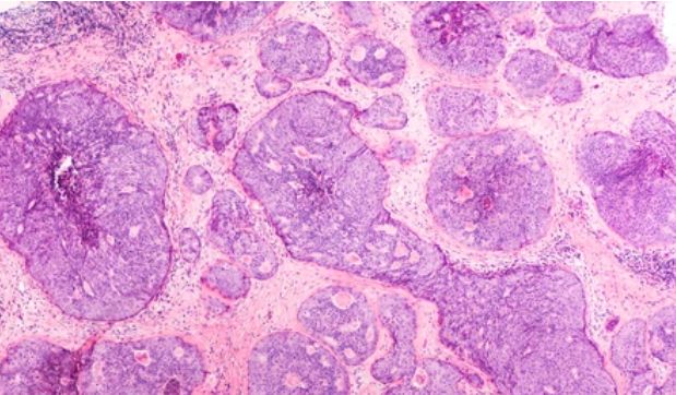 Breast Cancer Histopathological Analysis