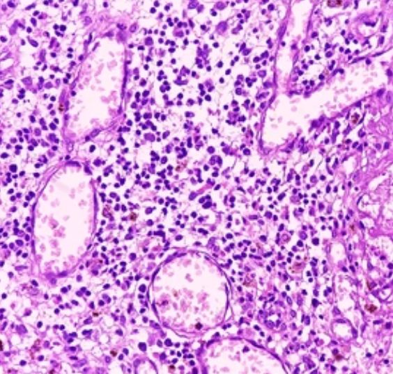 Invasive squamous cell carcinoma of the breast areola showing skin and soft tissue, atypical squamous epithelial malignancy.
