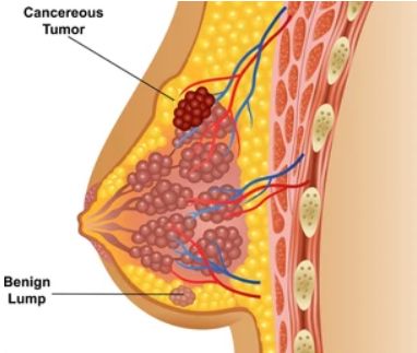 Breast cancer cell analysis services