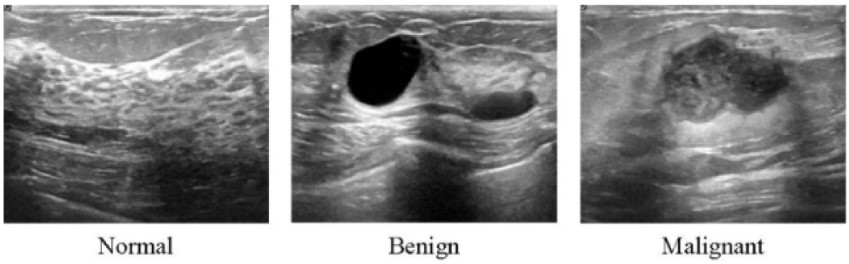 Ultrasound images from breast tissue for normal, benign, and malignant.