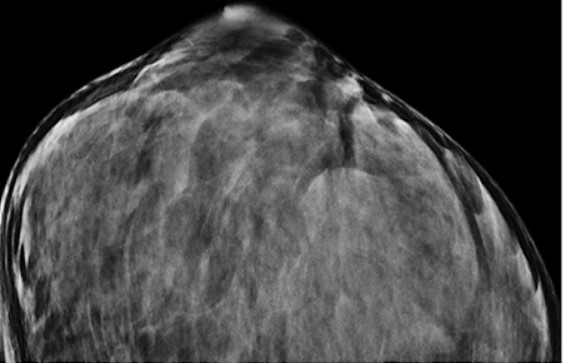 Ultrasound appearance of dense breasts.