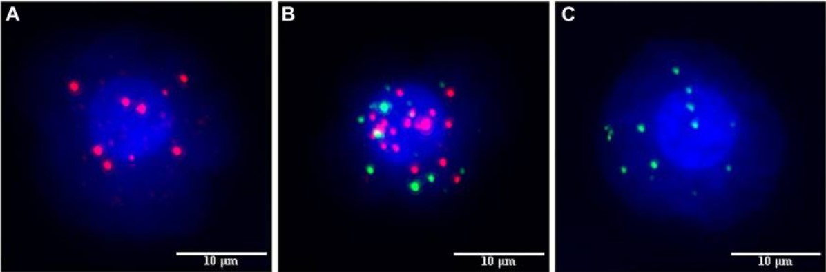 Fluorescent labeling of different types of circulating tumor cells in breast cancer.