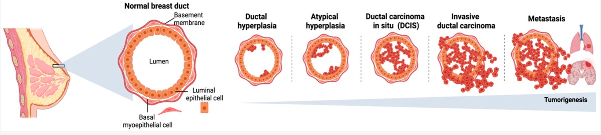 Subsequent steps in breast cancer tumorigenesis, from ductal hyperplasia to metastasis formation.